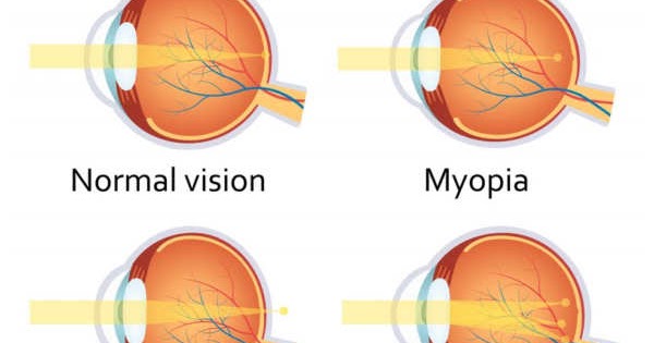 what does refractive error mean