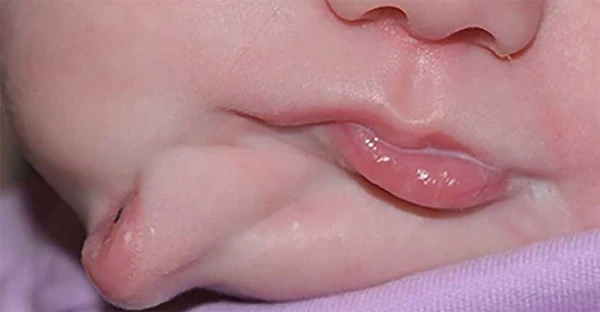 Rare condition causes US baby to be born with second mouth, New York, News, Doctor, World, Child, World, Health