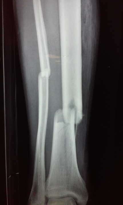 O R T O C R I T I C A: FRACTURA DE TIBIA Y PERONE