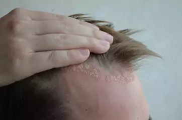 dandruff vs psoriasis dandruff vs psoriasis