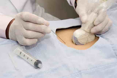 Amniocentesis procedure and test