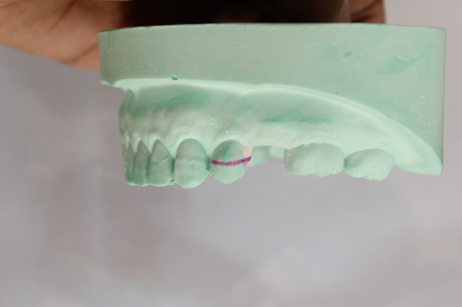 Step by step Guide for Understanding the Prosthodontics Making clasp