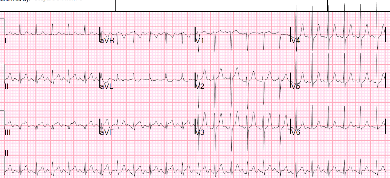 Dr. Smith's ECG Blog Tachycardia, Dehydration, and New ST Elevation in