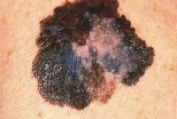  سرطان الجلد skin cancer 