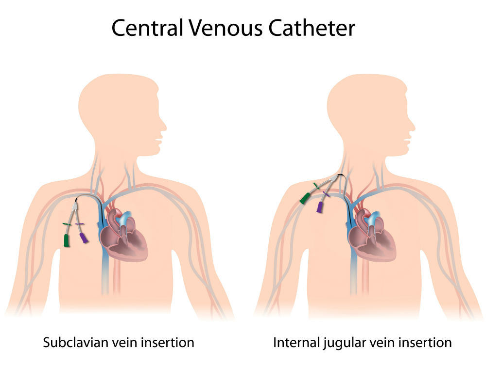 Selection of Catheter Insertion Site. Anesthesiology and Intensive Care