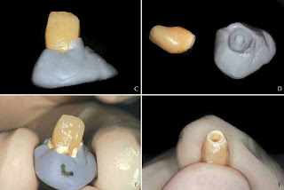 How to cement implant crown