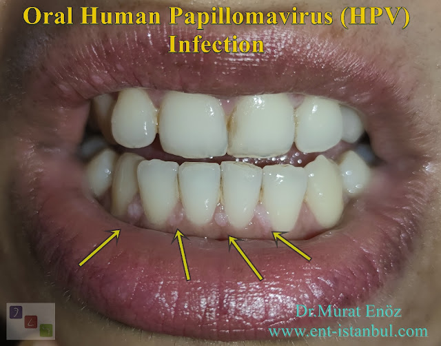 Oral Human Papillomavirus (HPV) Infection - Gingiva Papilloma