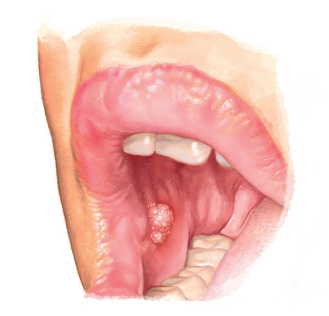 Medical Terms & Сlinical Сases Oral Wart (Squamous Papilloma)