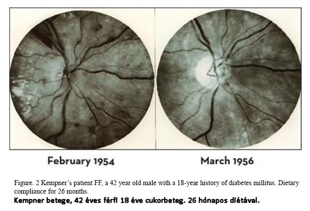 diabéteszes retinopátia