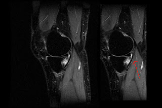 How to read an MRI right knee profile resonata magnetica ACL tear break ligament