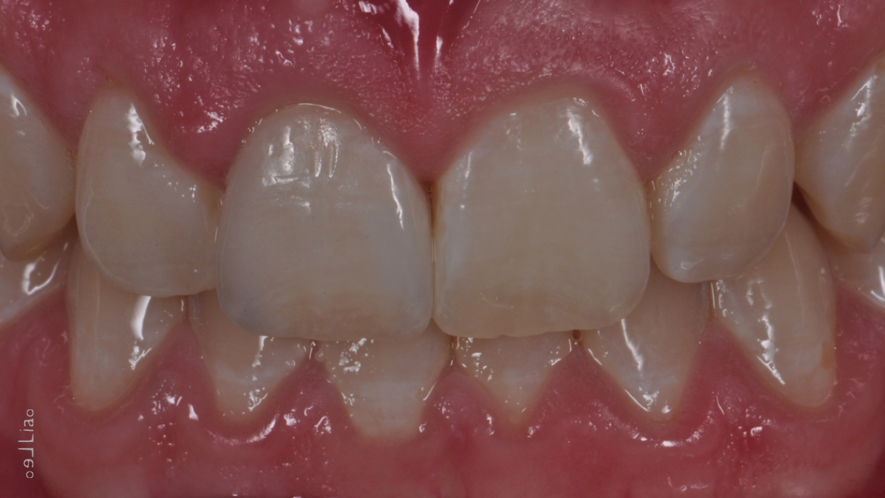 e.max LT BL4 Multilayered veneer. Beauty Smile Life