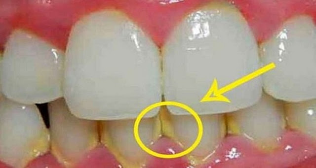 CÓMO QUITAR LA PLACA DENTAL EN 5 MINUTOS NATURALMENTE, SIN IR AL DENTISTA !!! CÓMO QUITAR LA PLACA DENTAL EN 5 MINUTOS NATURALMENTE, SIN IR AL DENTISTA !!!