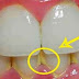 CÓMO QUITAR LA PLACA DENTAL EN 5 MINUTOS NATURALMENTE, SIN IR AL DENTISTA !!!