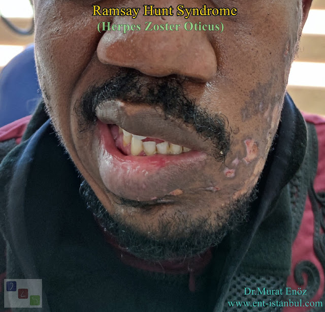 Ramsay Hunt Syndrome,Herpes Zoster Oticus, Peripheral facial paralysis, Otalgia, Vesicular rash on the external ear
