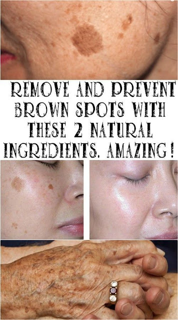 Remove and prevent brown spots with these 2 natural ingredients. Amazing!