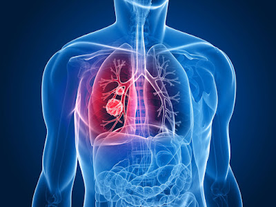 Akciğer Kanseri Nedir