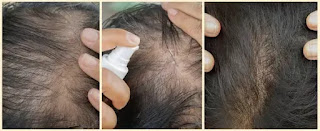 iron deficiency hair loss iron deficiency hair loss