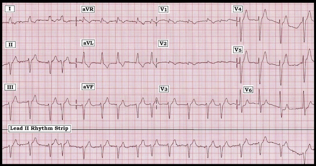 ivcd intraventricular conduction delay