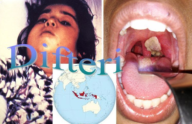 Difteri Di Indonesia