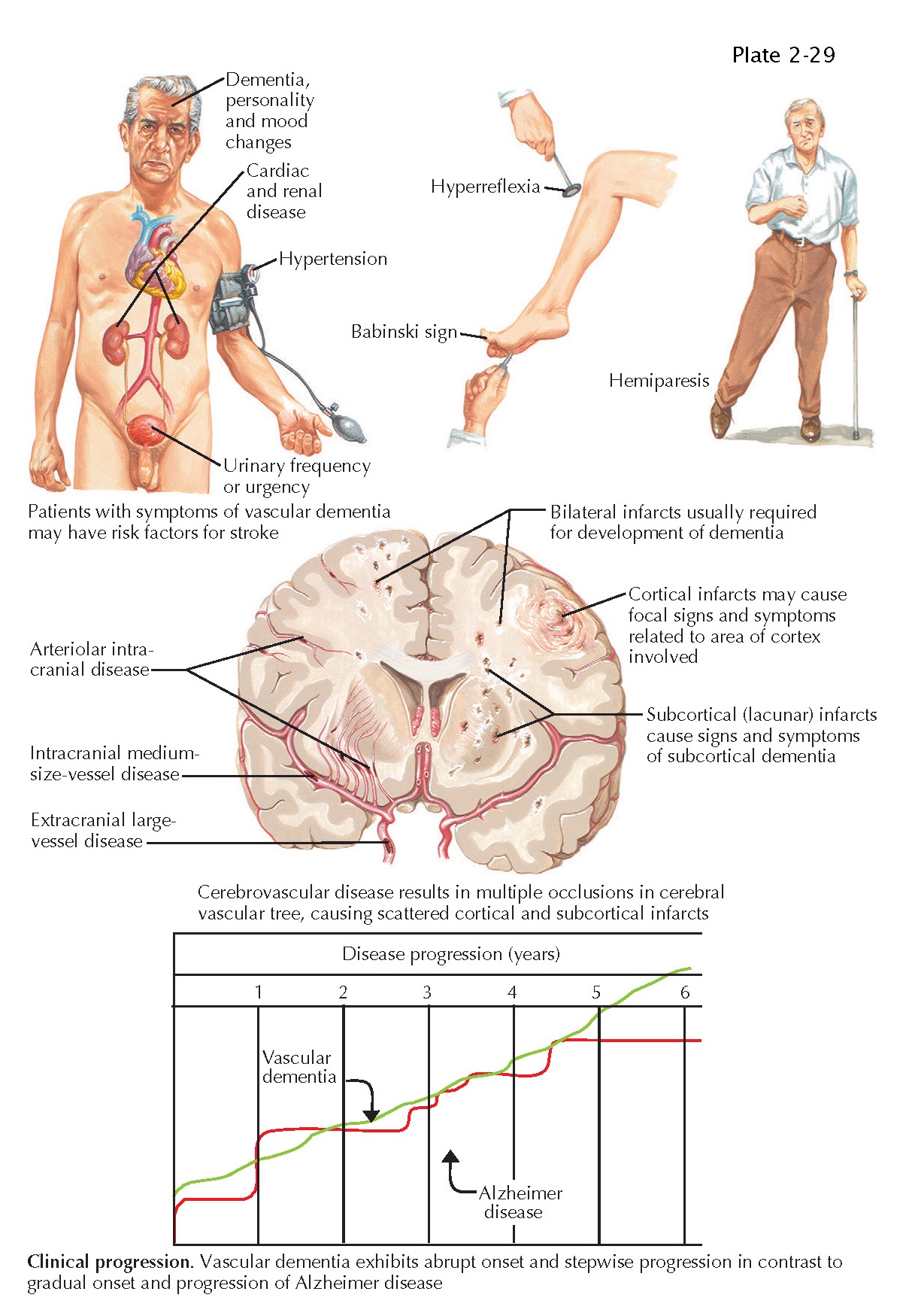 VASCULAR DEMENTIA pediagenosis