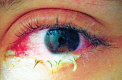 Cẩn thận với đau mắt đỏ!