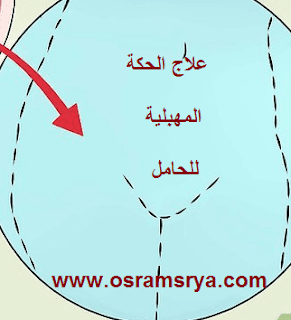 علاج الحكة المهبلية للحامل | علاج الجكة المهبلية في خمس خطوات منزلية |علاج الحكة المهبلية لغير المتزوجات