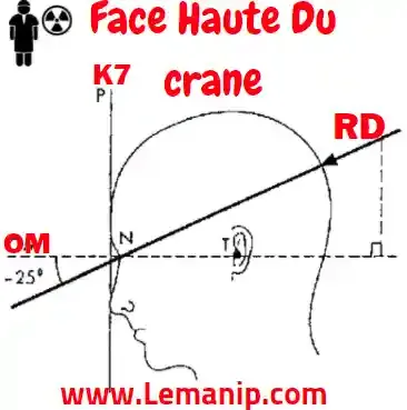 Incidence De Face Haute Du Crane (CALDWELL’S)