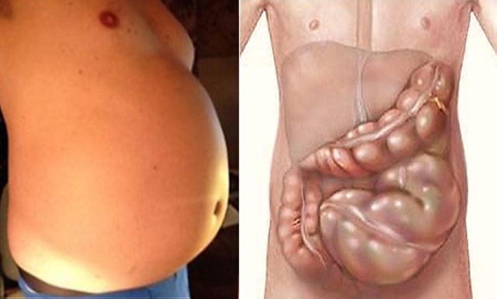 You Are Not Fat Your Stomach Is Bloated And Here Is How To Get Rid Of
