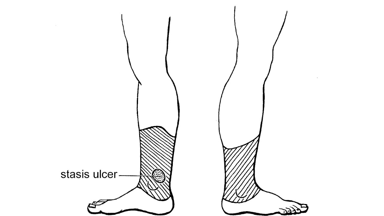 Venous Ulcer Definition Ulcer Choices