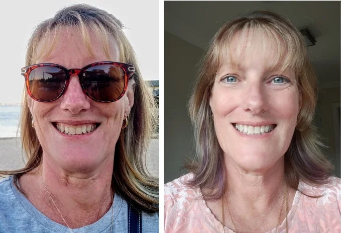 before and after tooth whitening and composite veneers July 2021