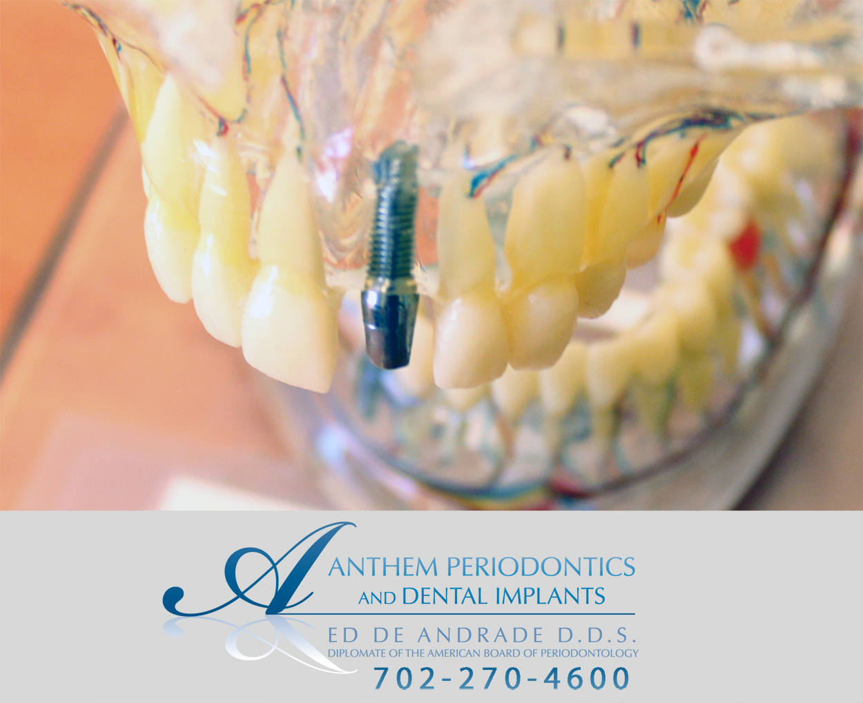 Dental Implants Las Vegas, Periodontist Las Vegas August 2013