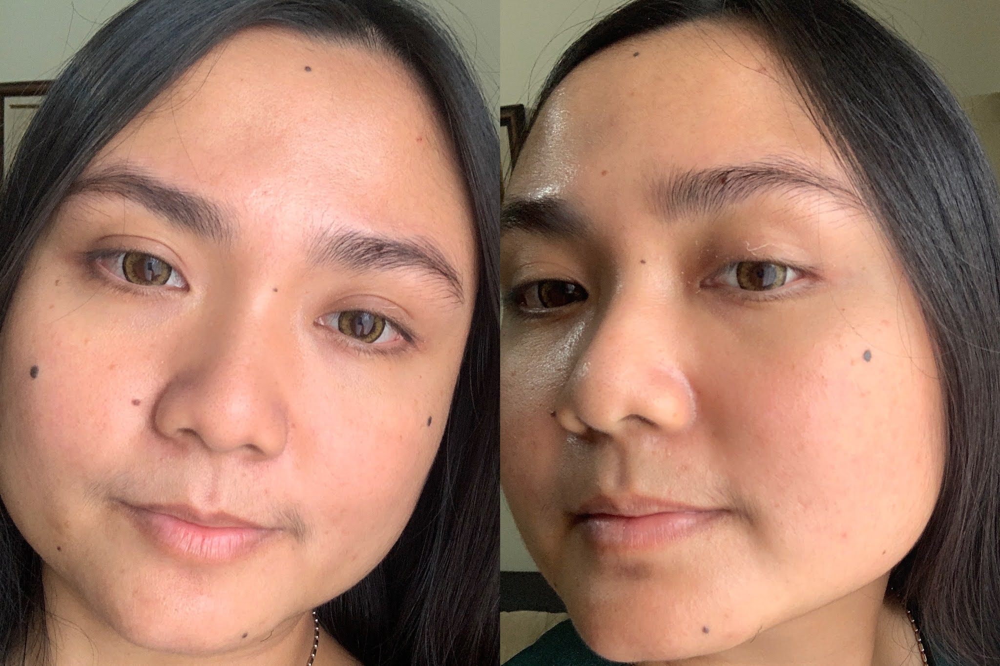 ZAP PHOTO FACIAL ACNE REVIEW IchaMauCerita