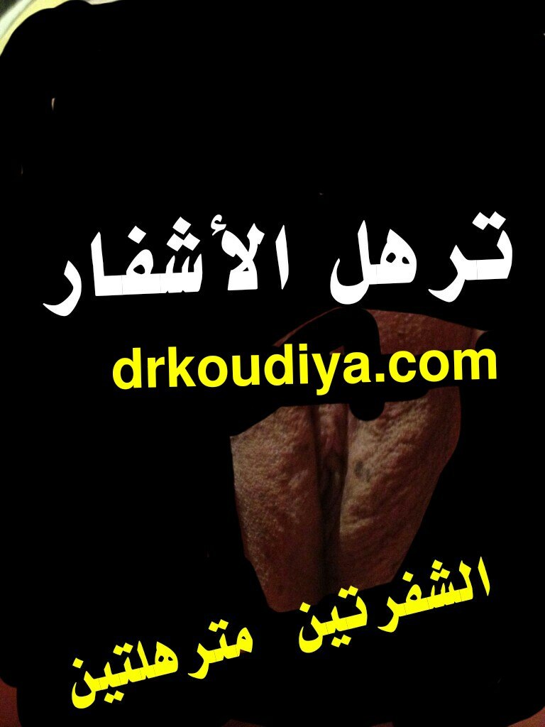 الأعشاب الطبيعية والعلاج بالطب البديل أنواع غشاء البكارة بالصور والفيديو وطريقة الكشف على العذرية