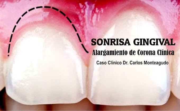SONRISA GINGIVAL: Alargamiento de Corona Clínica - Caso Clínico Dr. Carlos Monteagudo