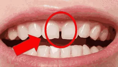 अगर आपके भी दांतों के बीच में है अंतर, तो यह खबर जरूर पढ़ें