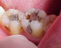 cara merawat gigi berlubang
