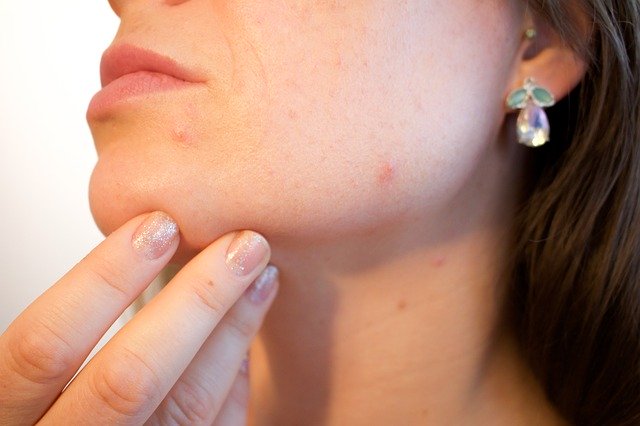 Acne Patches – Tips To Find The Best Pimple Patches that Clear Acne Overnight