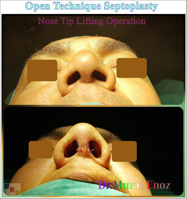 Nose tip lifting in İstanbul,Open technique nose tip plasty in İstanbul,open technique septoplasty in İstanbul,Open tecnique septoplasty operation,Nose tip lifting in Turkey,