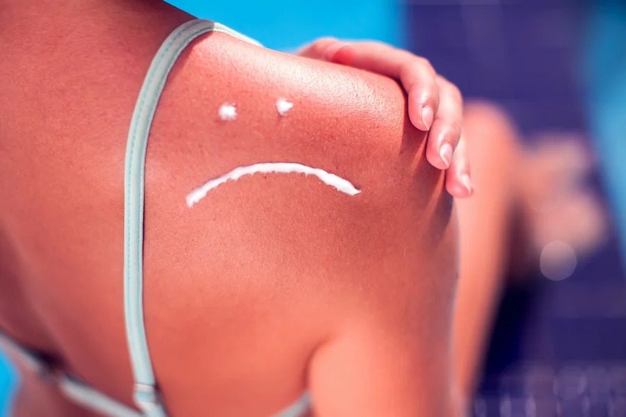 Da bị cháy nắng: Cách điều trị - chữa lành nhanh, hiệu quả nhất Da bị cháy nắng: Cách điều trị - chữa lành nhanh, hiệu quả nhất
