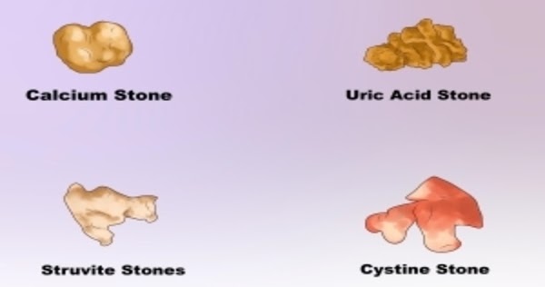 4-kinds-of-kidney-stones-and-symptoms