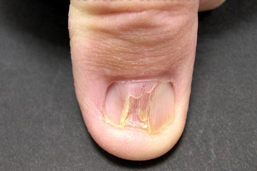 pterygium nails