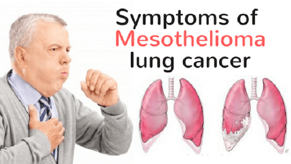 Mesothelioma Information: Some Common Questions About Mesothelioma