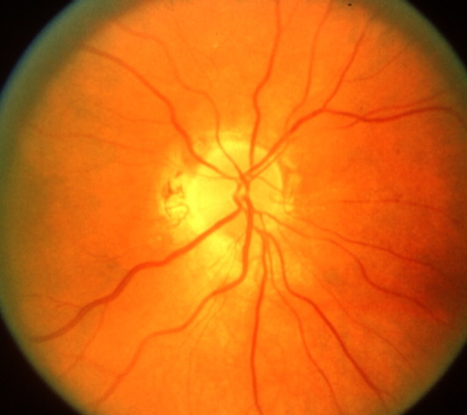 Аномалия развития зрительного нерва. Атрофия зрительного нерва Лебера. Наследственная оптическая нейропатия Лебера. Глиоз диска зрительного нерва.
