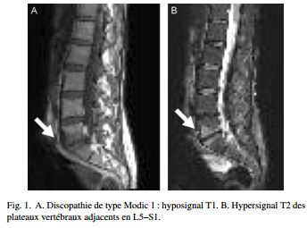Un médecin du sport vous informe: Les lombalgies.