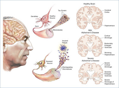 euMEDICINA: Alzheimerova choroba - začlenění konopného extraktu do farmakot
