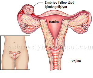 tubal gebelik, ektopik gebelik, dış gebelik