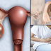 For All Women: Needs To Know The Signs And Symptoms Of Ovarian Disease
