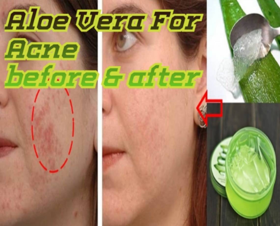 8 beauty benefits of applying aloe vera gel on face and skin everyday