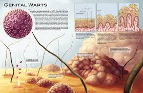 GENITAL WARTS / KUTIL KELAMIN JENGGER AYAM