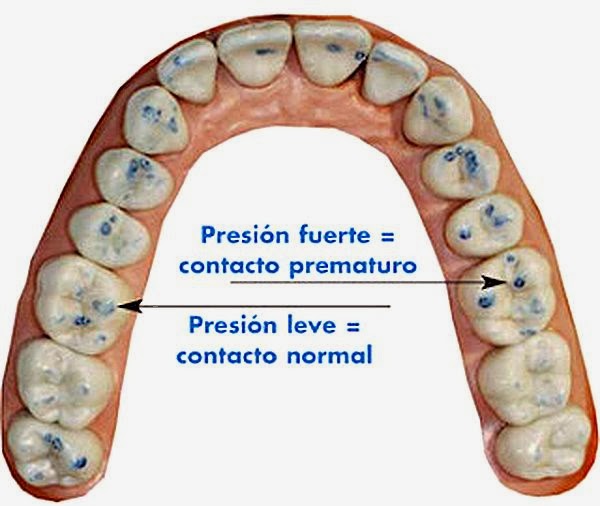 OCLUSIÓN: Contactos Prematuros y los Papeles de Articular Bausch